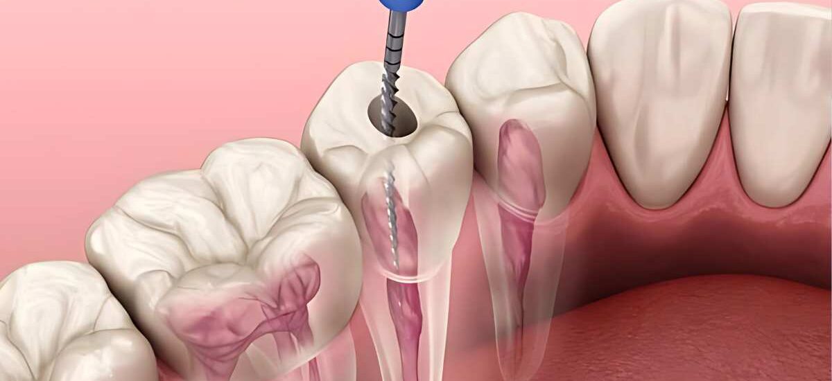 Root Canal Treatment in Kathmandu
