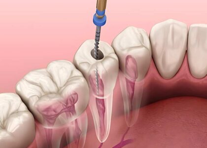 Root Canal Treatment in Kathmandu