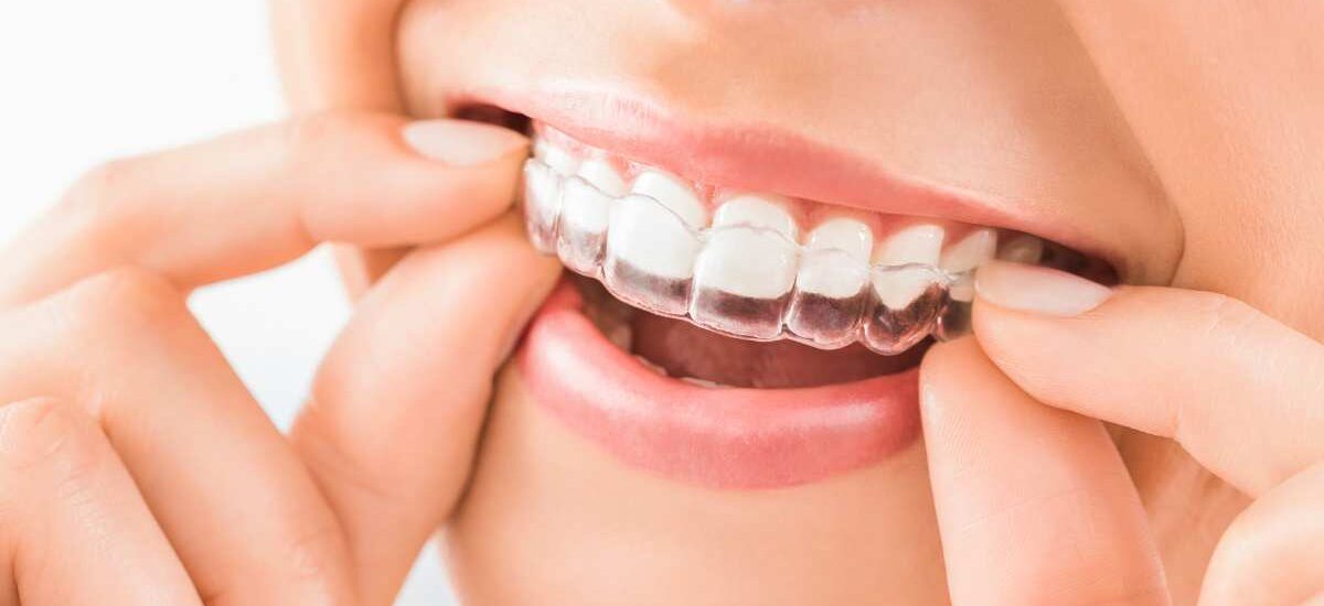 Clear Aligner in Kathmandu