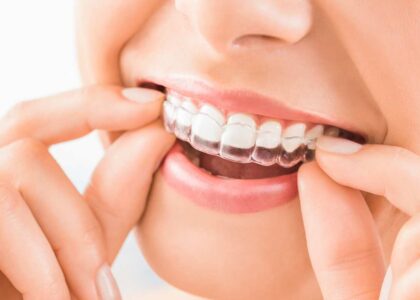 Clear Aligner in Kathmandu
