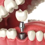 Dental Implant in Kathmandu