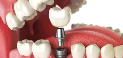 Dental Implant in Kathmandu