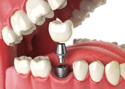 Dental Implant in Kathmandu