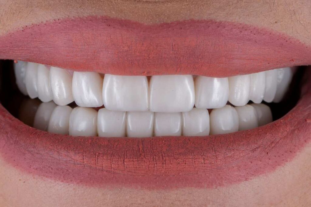 Zirconia & E-Max crown in Kathmandu