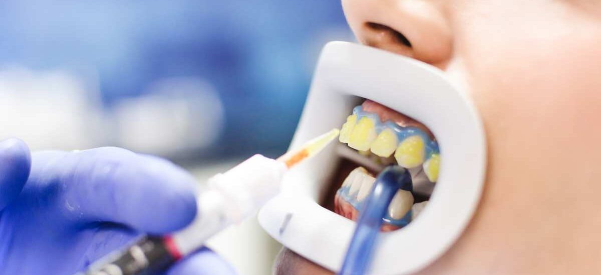 Teeth Bleaching in Kathmandu