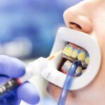 Teeth Bleaching in Kathmandu