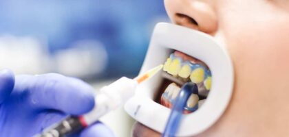Teeth Bleaching in Kathmandu