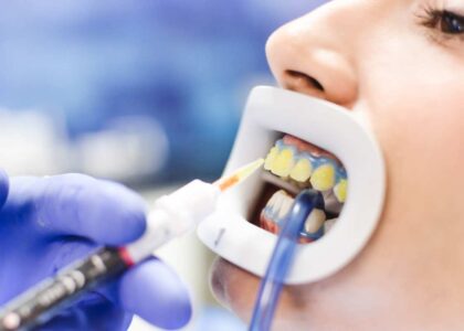 Teeth Bleaching in Kathmandu