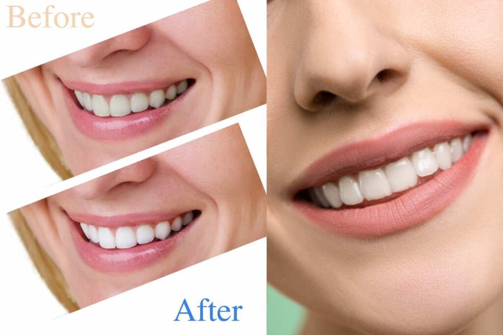 Teeth Bleaching in Kathmandu