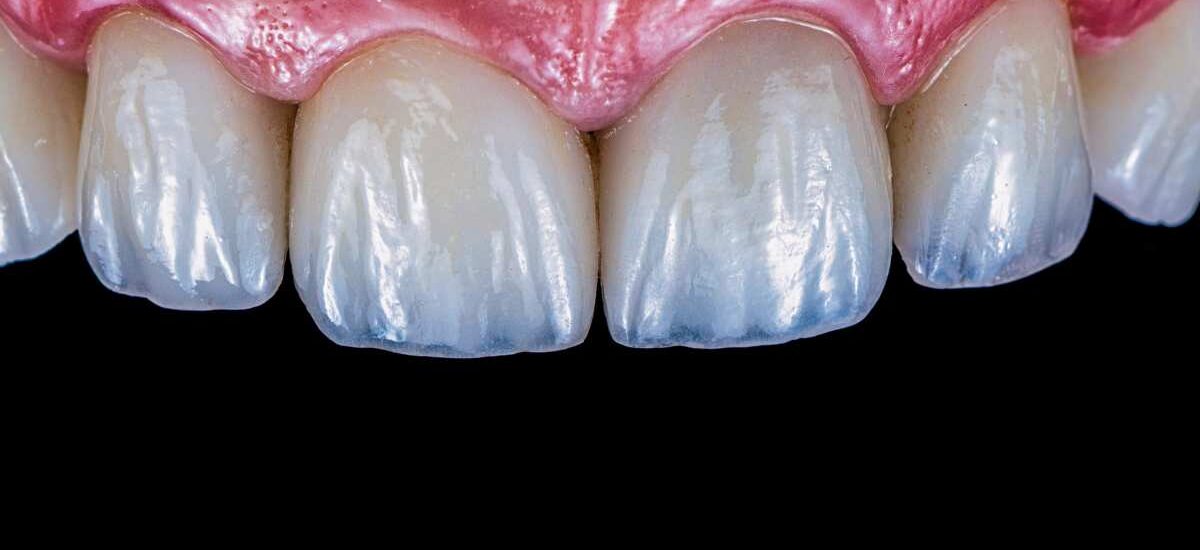 Veneers in Kathmandu