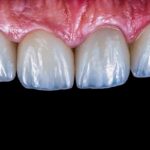 Veneers in Kathmandu