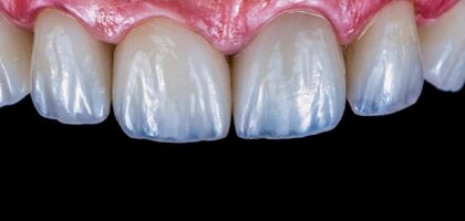 Veneers in Kathmandu
