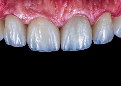 Veneers in Kathmandu