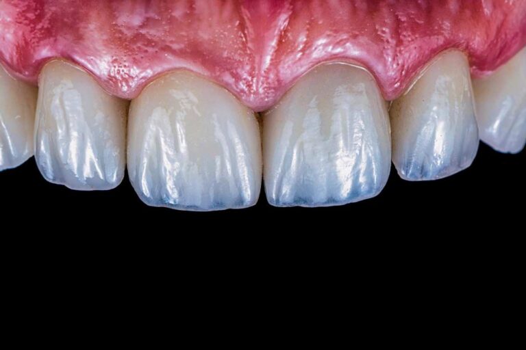 Veneers in Kathmandu