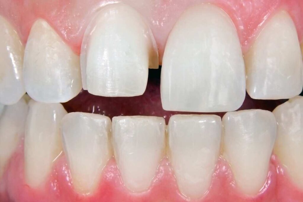 Veneers in Kathmandu