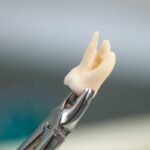 Wisdom tooth extraction in Kathmandu