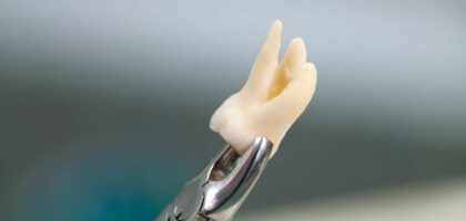 Wisdom tooth extraction in Kathmandu