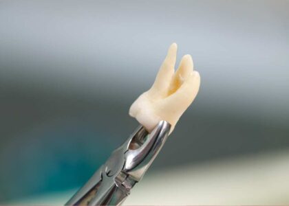 Wisdom tooth extraction in Kathmandu