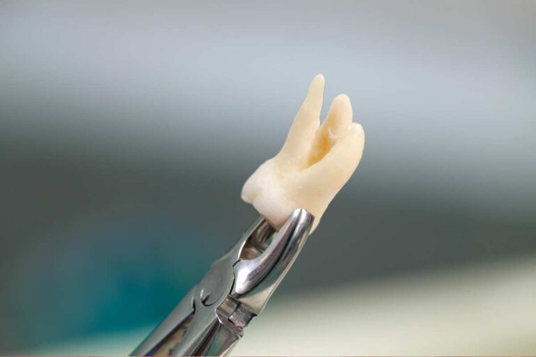 Wisdom Tooth Extraction in Kathmandu