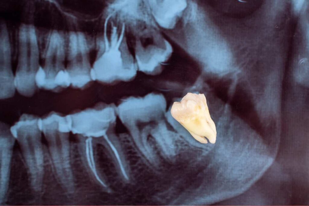 Wisdom tooth extraction in Kathmandu