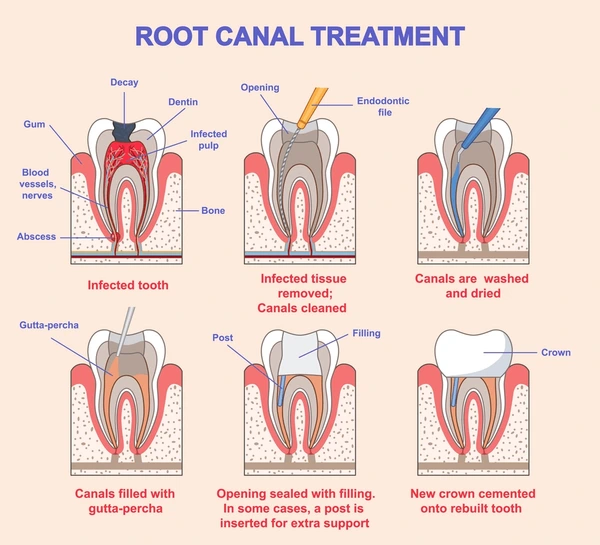 Root Canal Treatment in Kathmandu