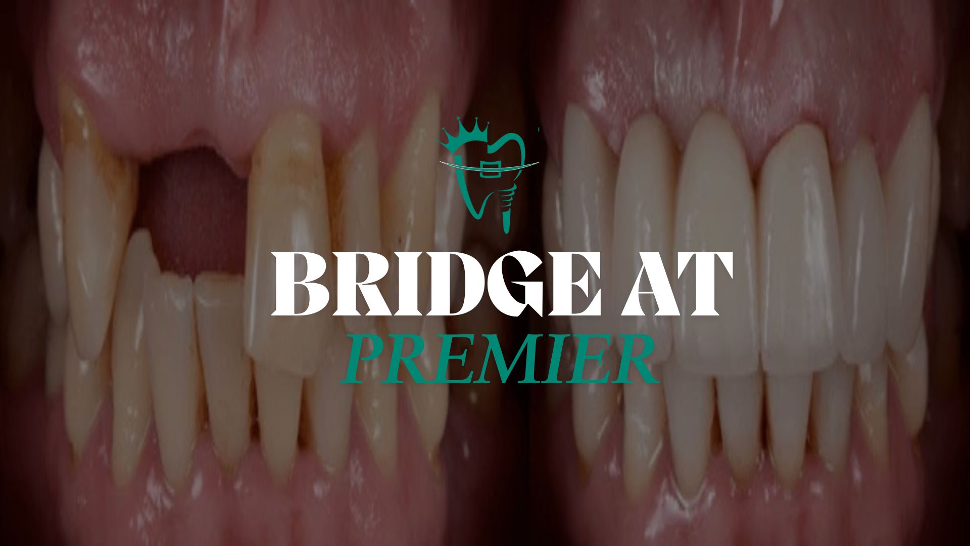 Dental crowns and bridges price in Nepal - Before and after dental bridge placement