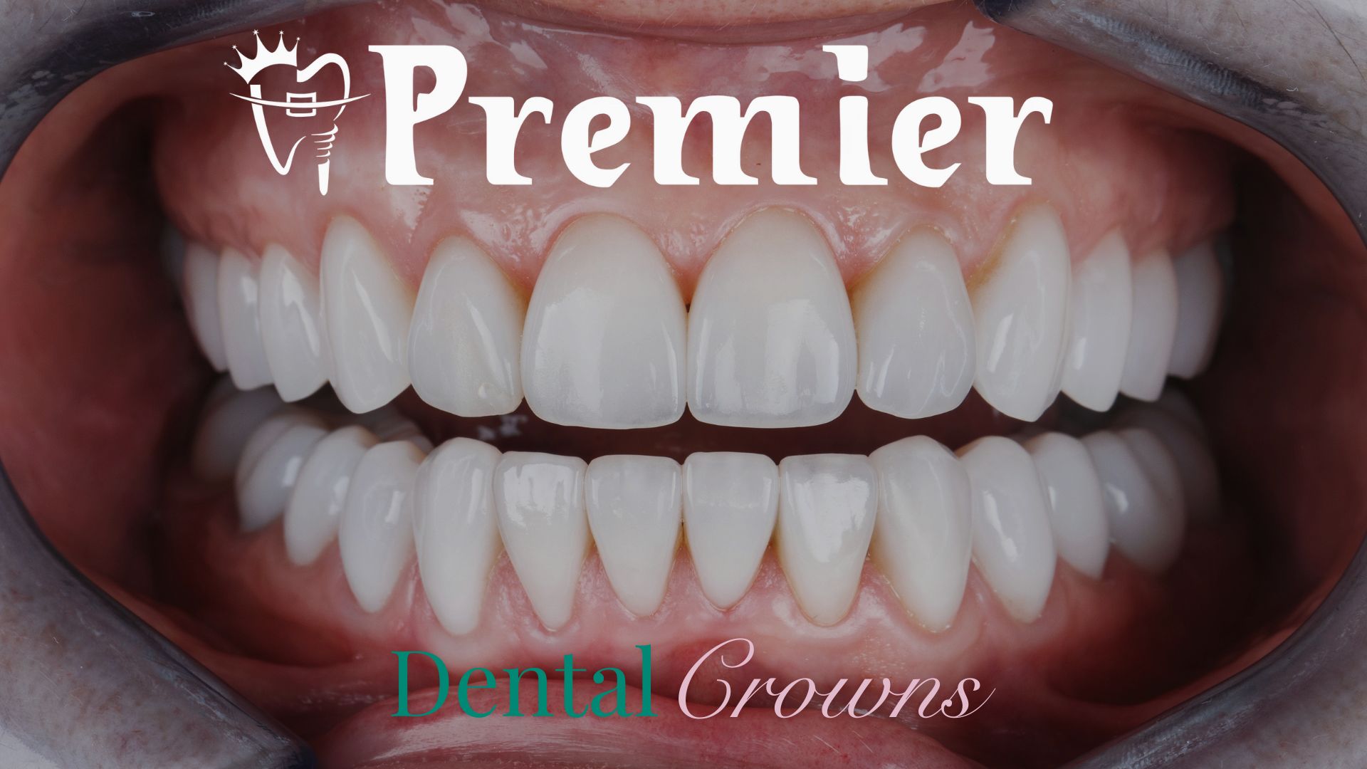 Dental crowns and bridges price in Nepal - Different types of dental crown materials