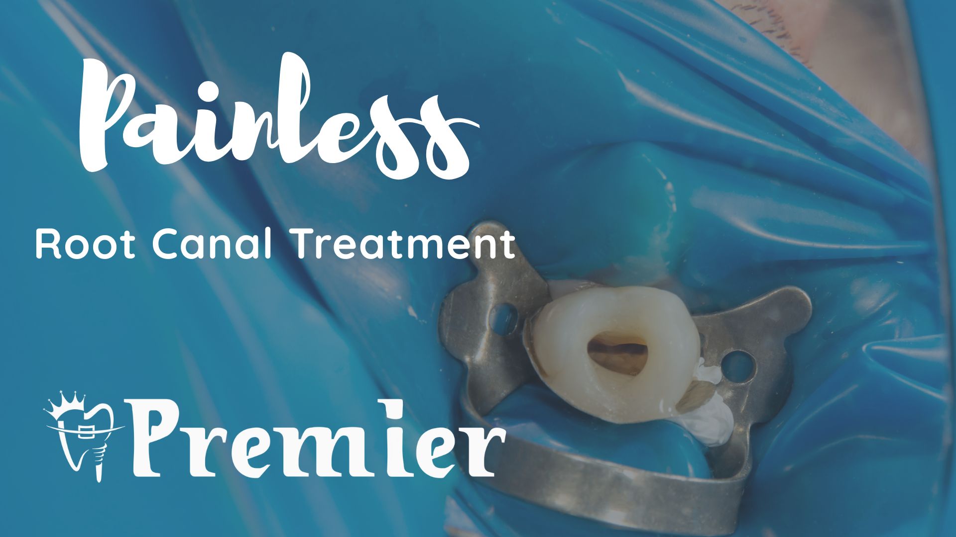 Price of root canal treatment in Kathmandu, Nepal - Patient receiving painless RCT at Premier Dental