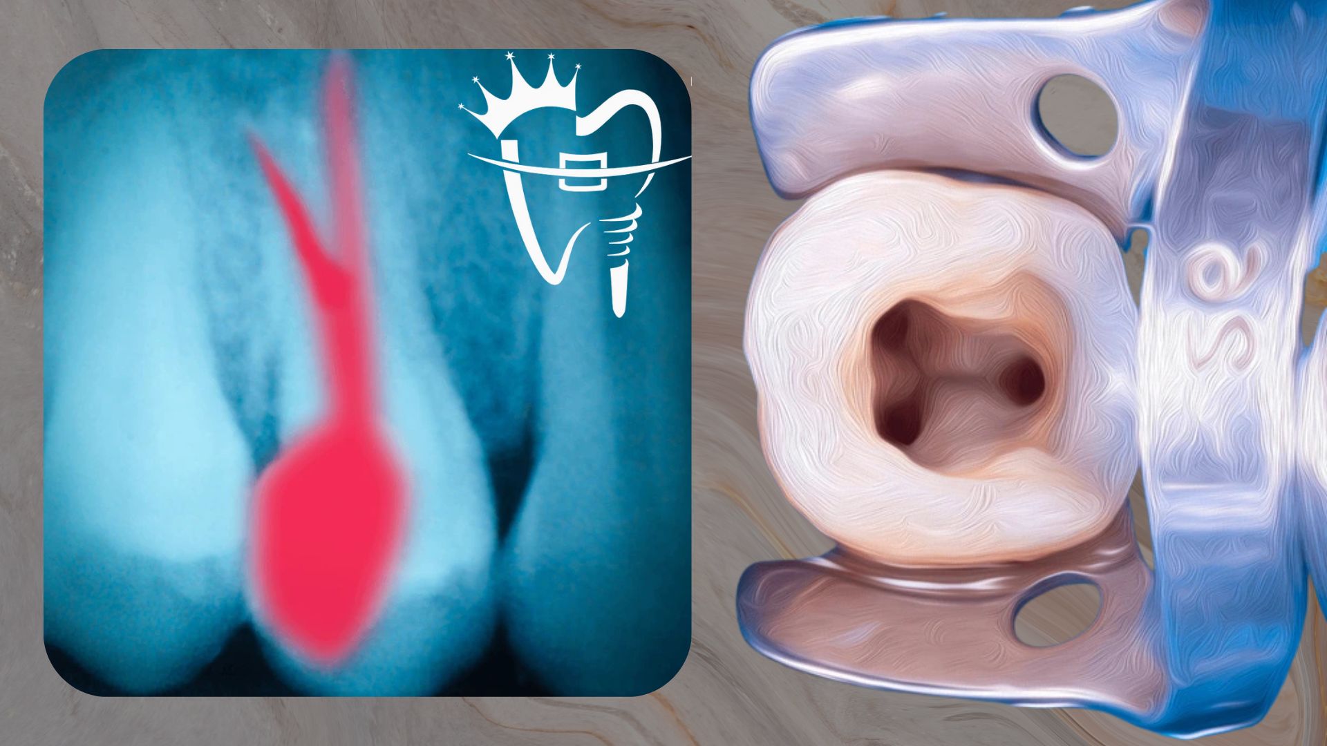 Price of root canal treatment in Kathmandu, Nepal - Steps in root canal treatment at Premier Dental