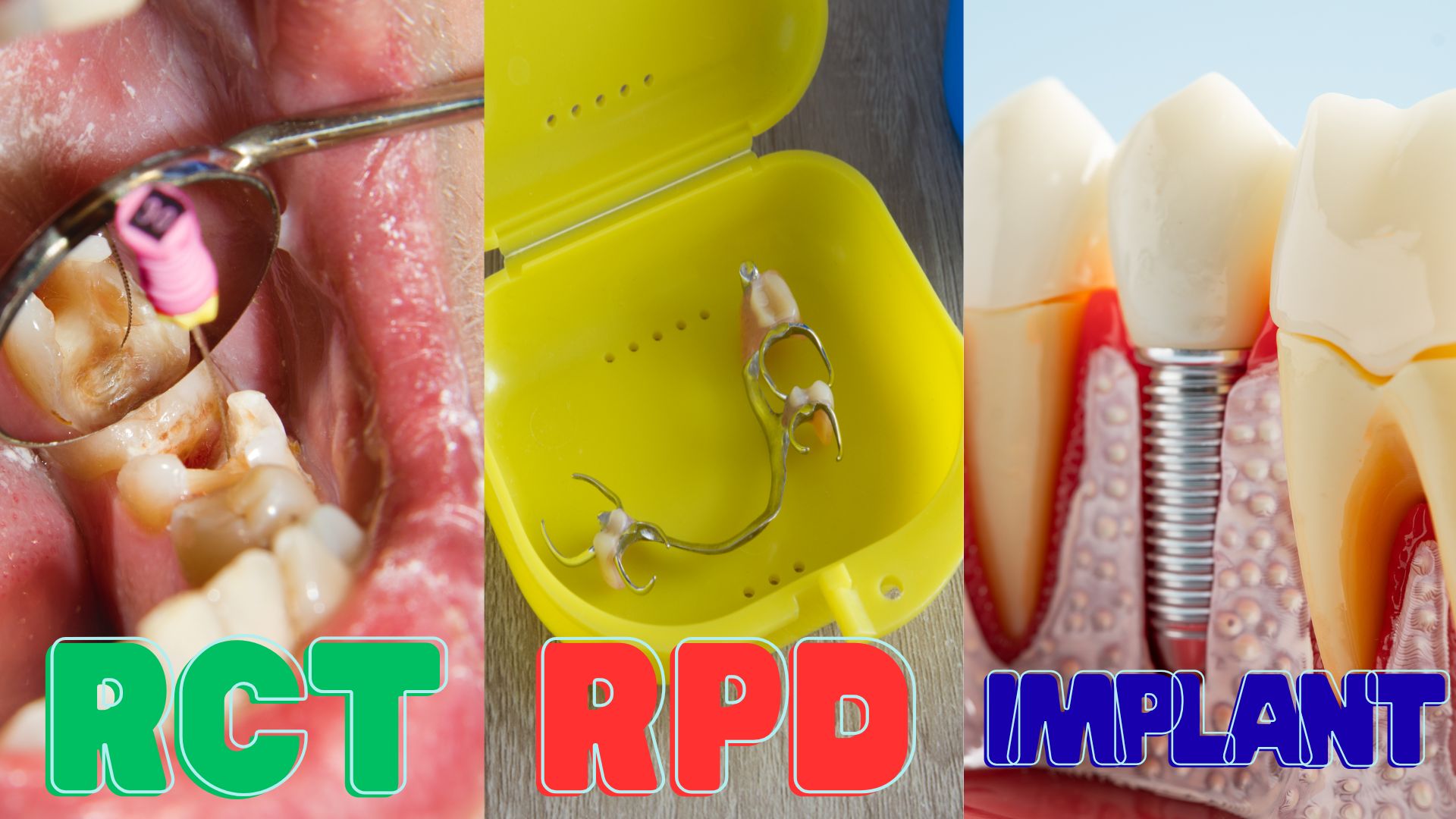 Price of root canal treatment in Kathmandu, Nepal - Comparison of RCT vs RPD vs Implant options