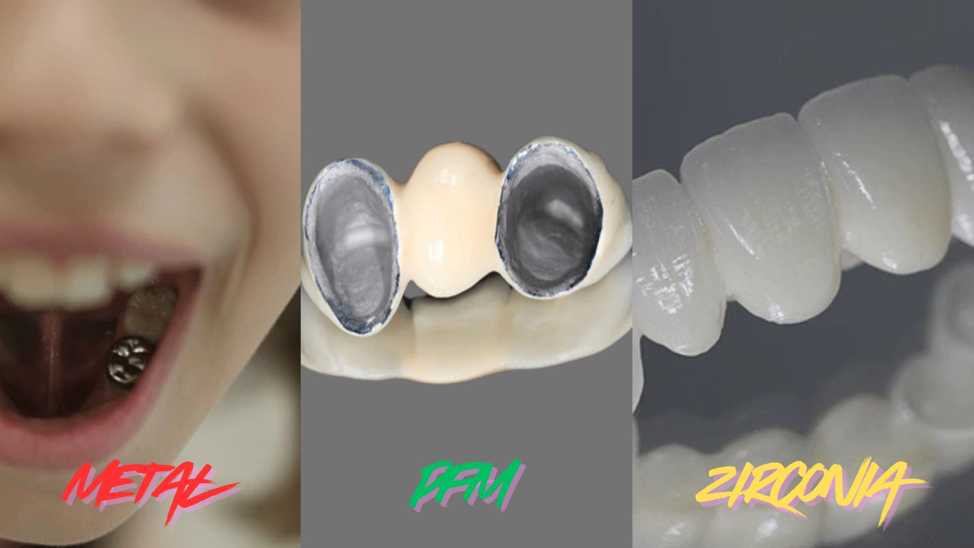Dental crowns and bridges price in Nepal - Different types of dental crowns at Premier Dental
