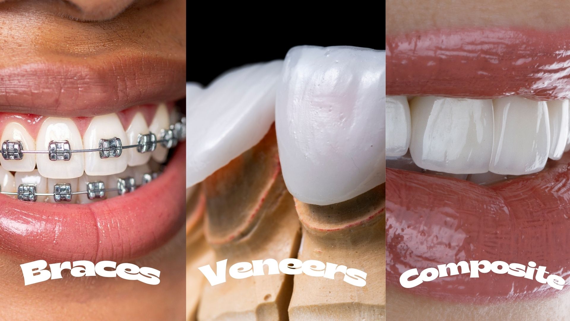 Price of braces in Kathmandu, Nepal - Comparison of braces vs cosmetic alternatives like veneers and composite