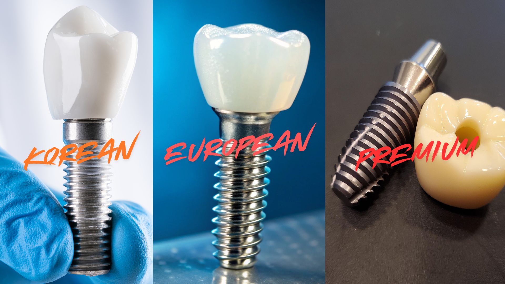 Price of dental implants in Kathmandu, Nepal - Comparison of Korean, European, and Premium dental implant systems