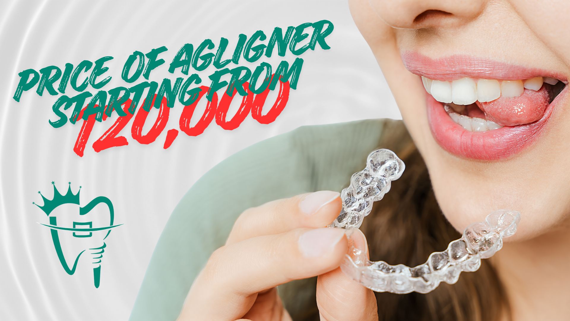Price of Clear Aligner in Kathmandu - Starting from 120,000