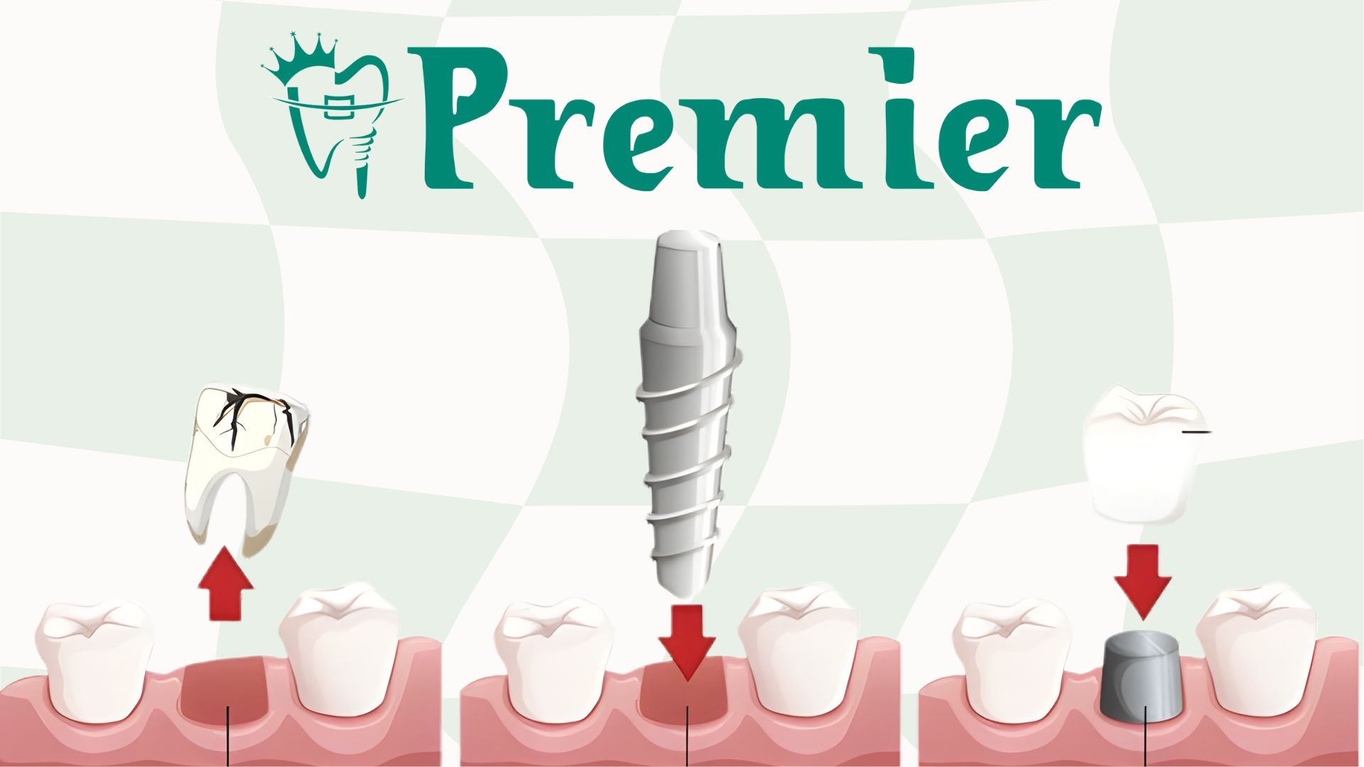 Price of dental implants in Kathmandu, Nepal - Steps in dental implant process from consultation to final crown