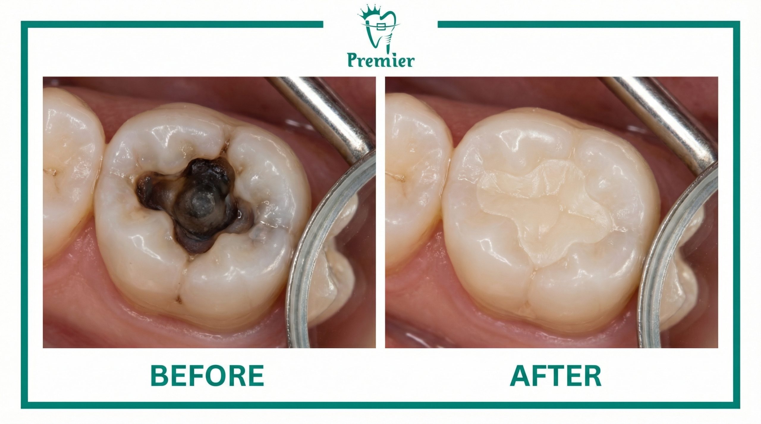 Best Dental Fillings in Kathmandu Nepal