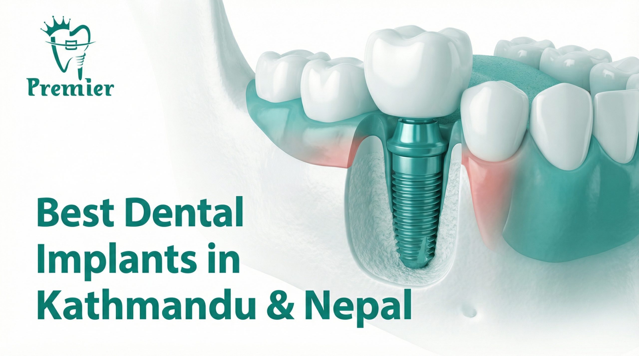 Best Dental Implants in Kathmandu Nepal - Premier Dental